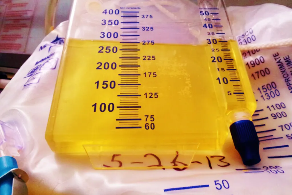 catheter concept measuring urine output after birth